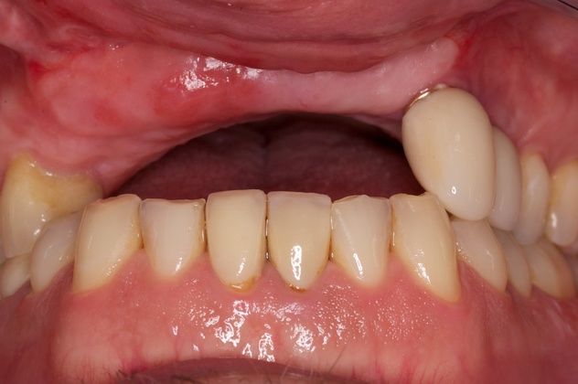 Missing upper teeth due to injury